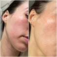 What Is Contact Dermatitis? A Doctor Explains the Skin Condition